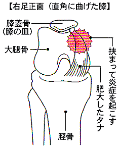 タナ障害 タナ障害